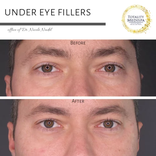 Neurotoxins (Botox, Newtox, Xeomin) Before and After Photo by Totality Medispa in Charleston, SC
