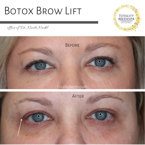Neurotoxins (Botox, Newtox, Xeomin) Before and After Photo by Totality Medispa in Charleston, SC