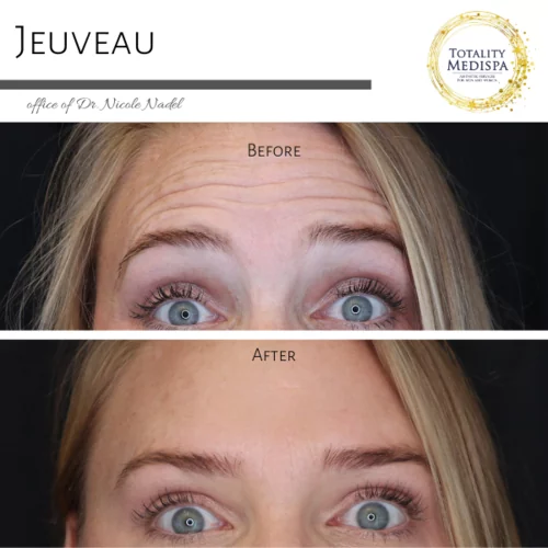 Neurotoxins (Botox, Newtox, Xeomin) Before and After Photo by Totality Medispa in Charleston, SC