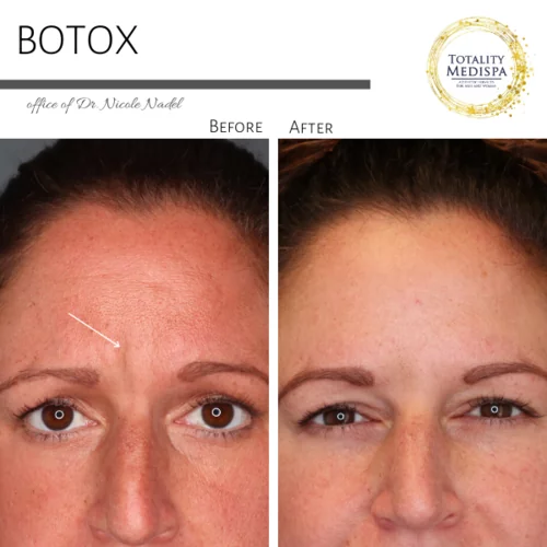 Neurotoxins (Botox, Newtox, Xeomin) Before and After Photo by Totality Medispa in Charleston, SC