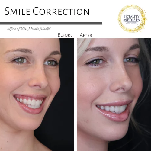 Neurotoxins (Botox, Newtox, Xeomin) Before and After Photo by Totality Medispa in Charleston, SC