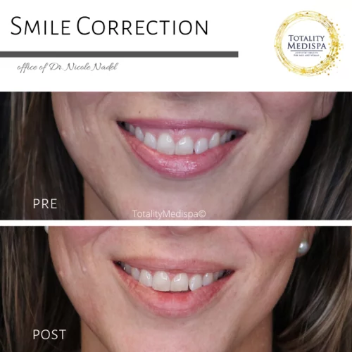Neurotoxins (Botox, Newtox, Xeomin) Before and After Photo by Totality Medispa in Charleston, SC