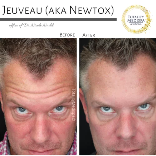 Neurotoxins (Botox, Newtox, Xeomin) Before and After Photo by Totality Medispa in Charleston, SC