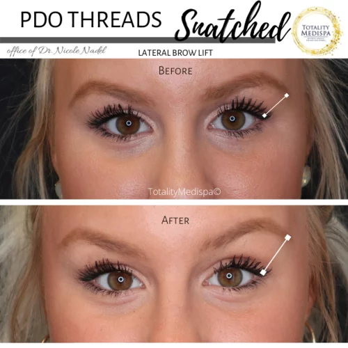 PDO Threads Before and After Photo by Totality Medispa in Charleston, SC