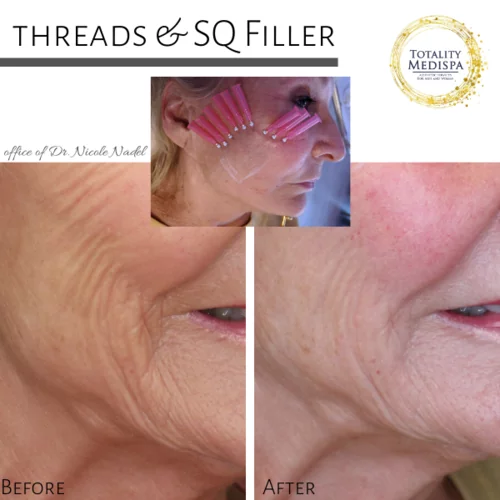 PDO Threads Before and After Photo by Totality Medispa in Charleston, SC