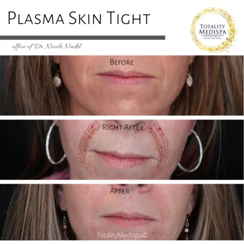 Plasma Pen Tightening Before and After Photo by Totality Medispa in Charleston, SC
