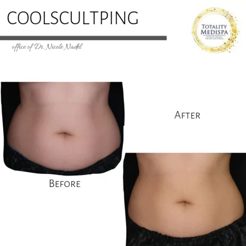 Plasma Pen Tightening Before and After Photo by Totality Medispa in Charleston, SC