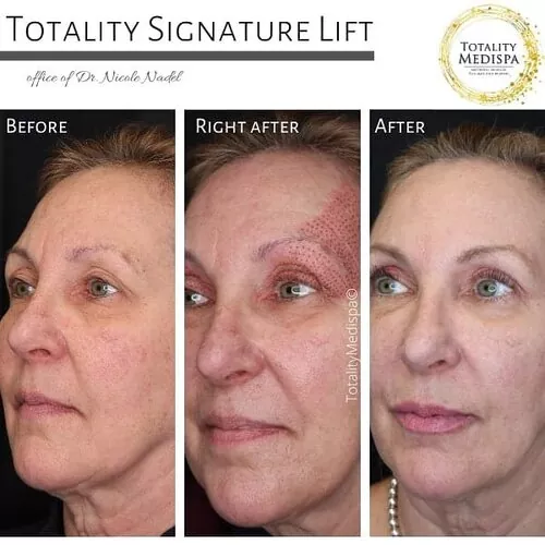 Plasma Pen Tightening Before and After Photo by Totality Medispa in Charleston, SC