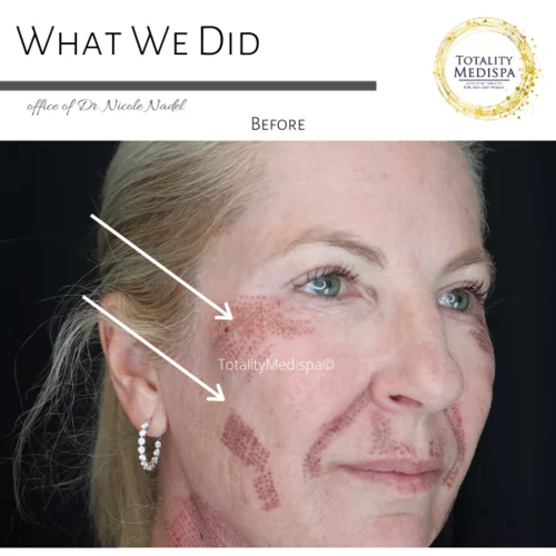 Plasma Pen Tightening Before and After Photo by Totality Medispa in Charleston, SC