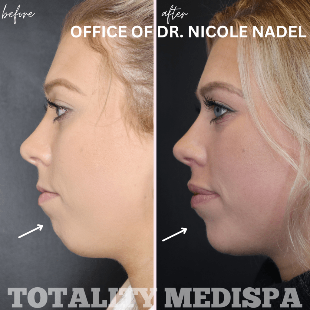 Chin Augmentation Before and After Photo by Totality Medispa in Charleston, SC