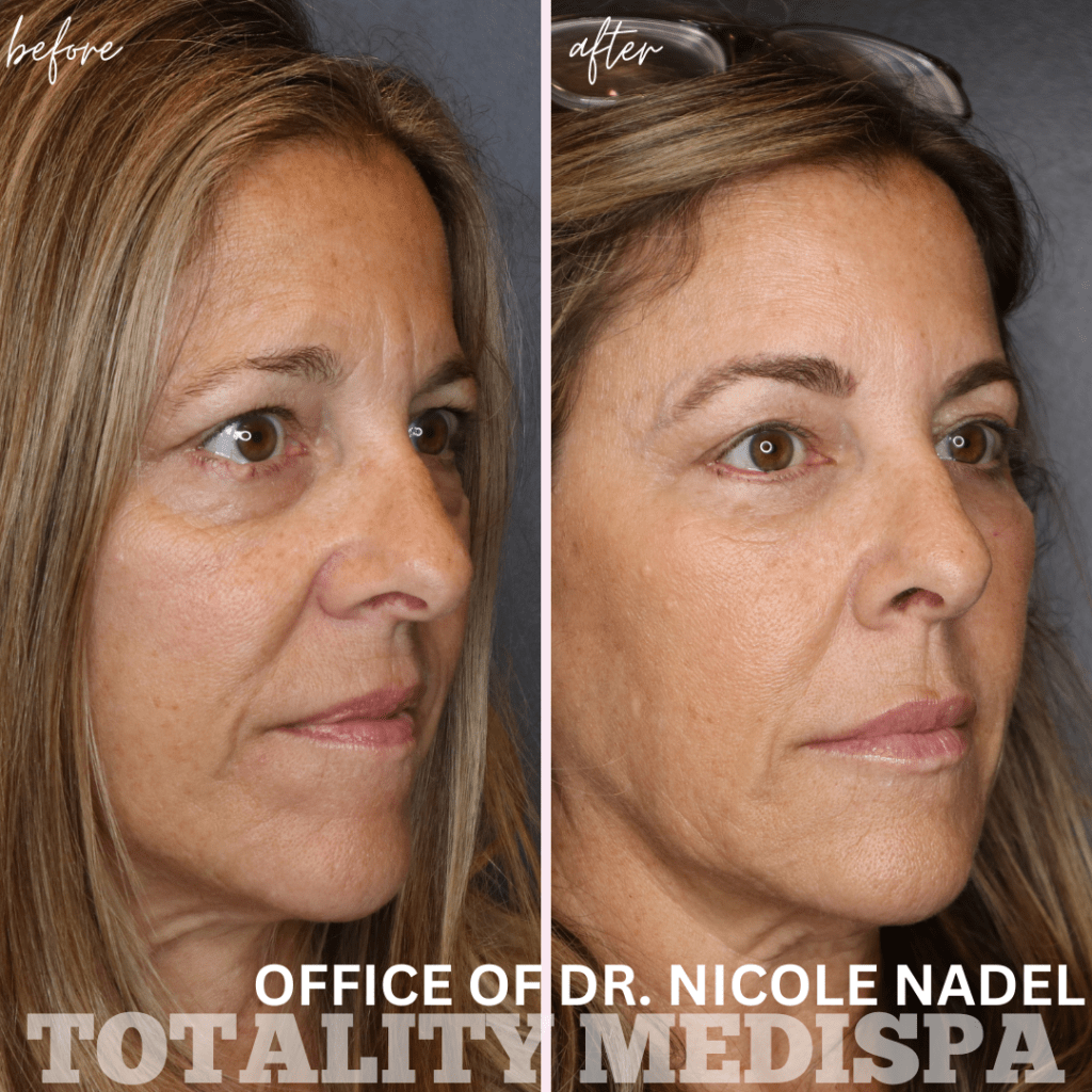 Facelift Before and After Photo by Totality Medispa in Charleston, SC