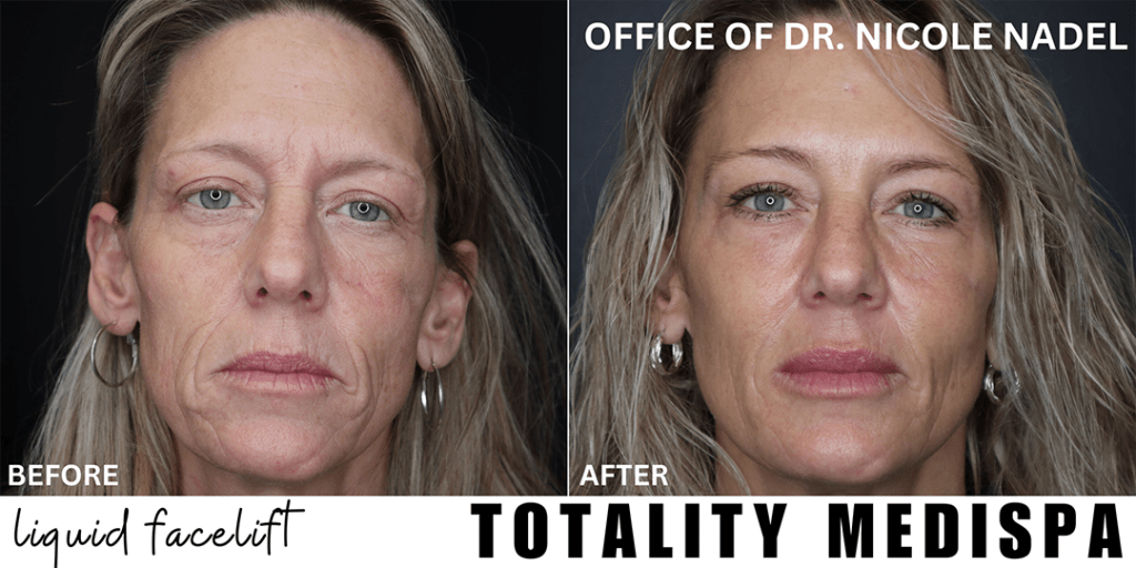 Facelift Before and After Photo by Totality Medispa in Charleston, SC