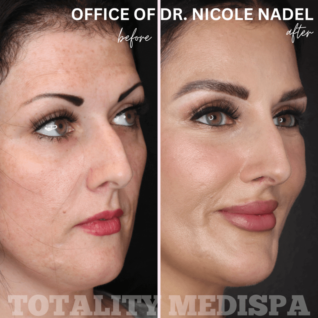 Facelift Before and After Photo by Totality Medispa in Charleston, SC