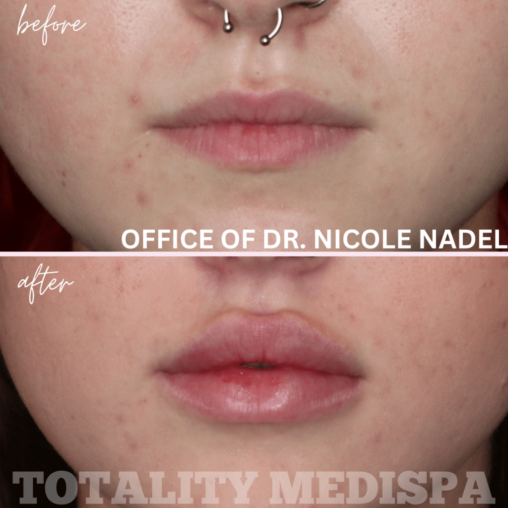 Lip Filler Before and After Photo by Totality Medispa in Charleston, SC