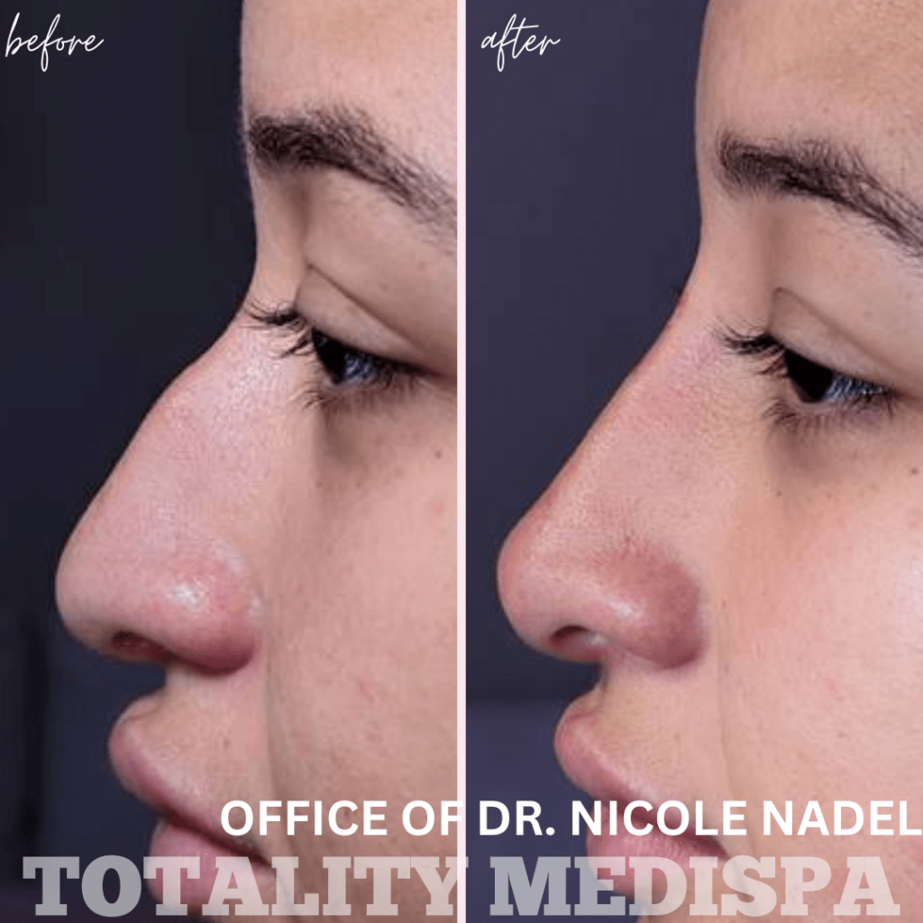 Liquid Rhinoplasty Before and After Photo by Totality Medispa in Charleston, SC