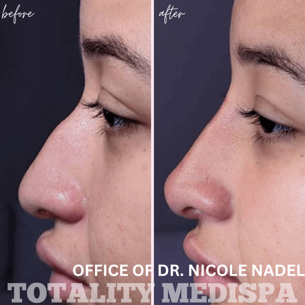 Liquid Rhinoplasty Before and After Photo by Totality Medispa in Charleston, SC