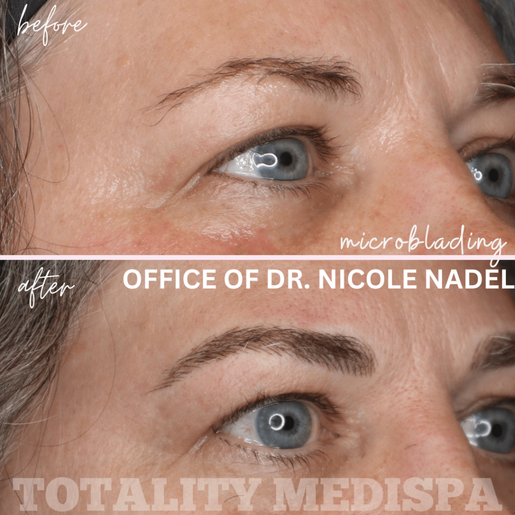 Microblading Before and After Photo by Totality Medispa in Charleston, SC