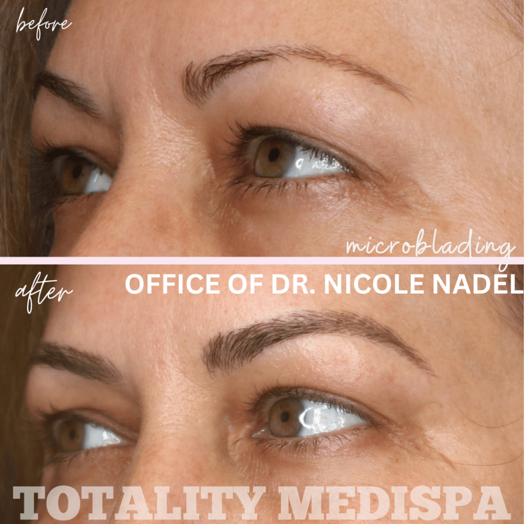 Microblading Before and After Photo by Totality Medispa in Charleston, SC